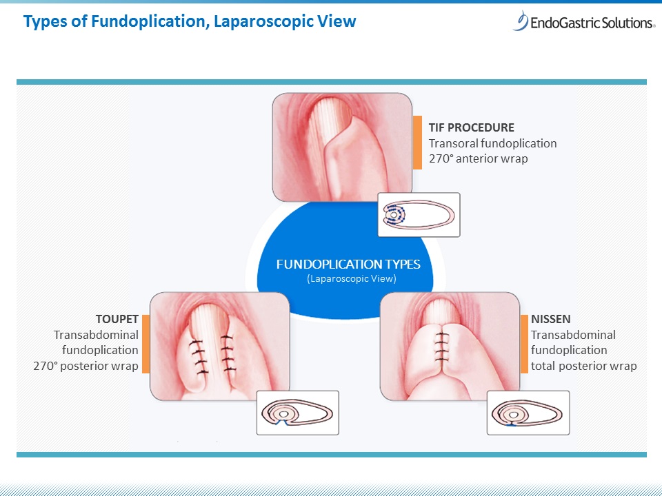 Antireflux Surgery Fundoplicaiton Types Laparoscopic View