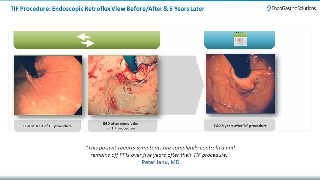 After the TIF procedure.