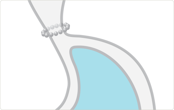Magnetic Sphincter Augmentation