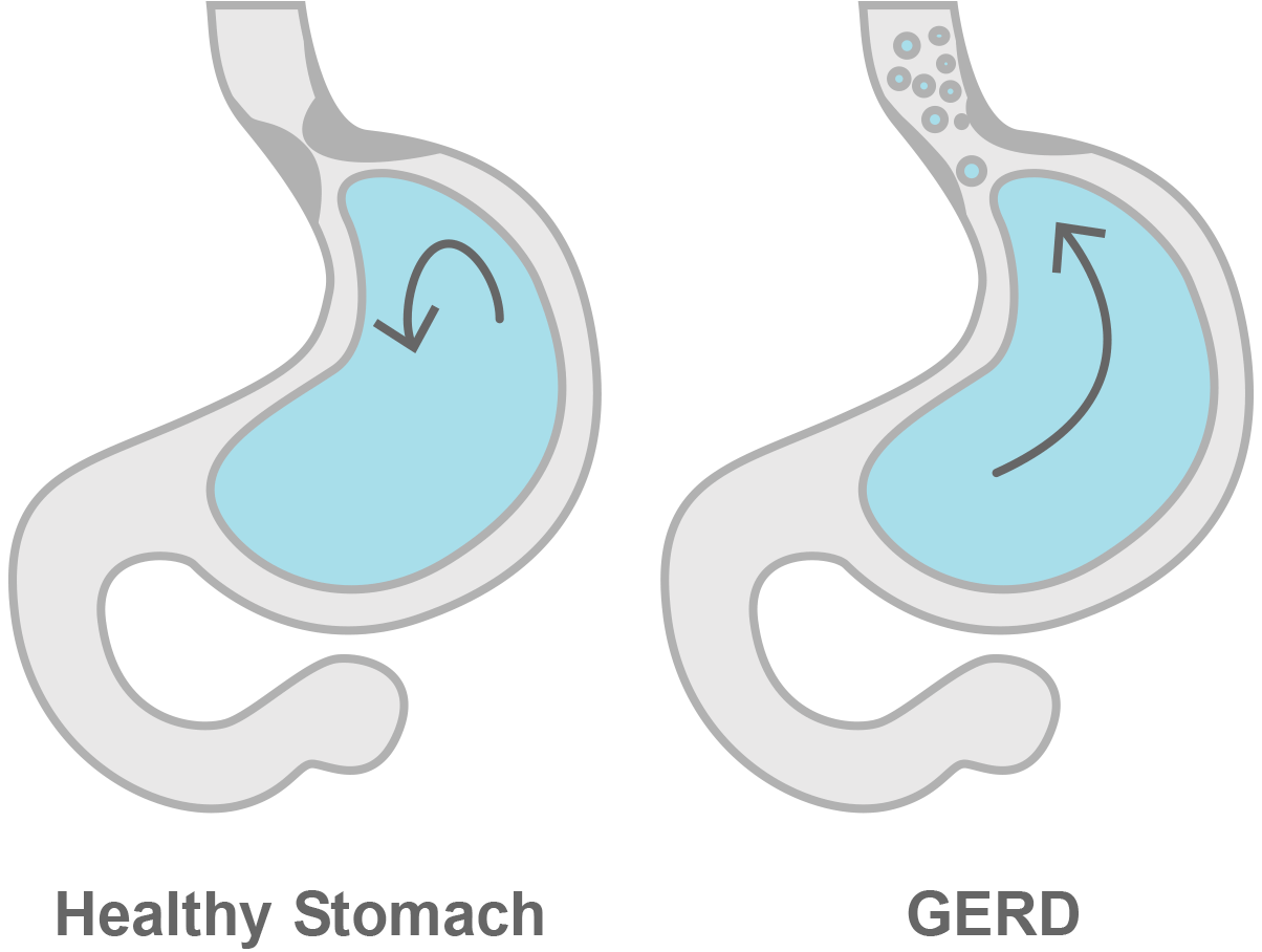 Healthy Stomach and GERD Stomach