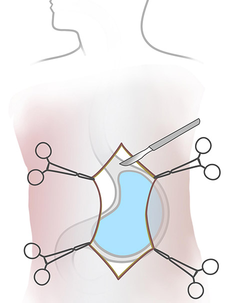 Open Nissen Surgery