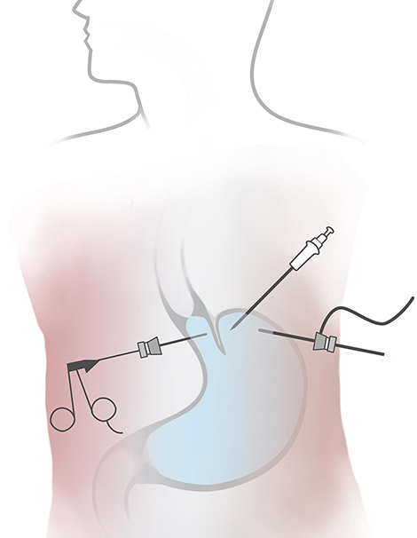 Laparoscopic Nissen Surgery