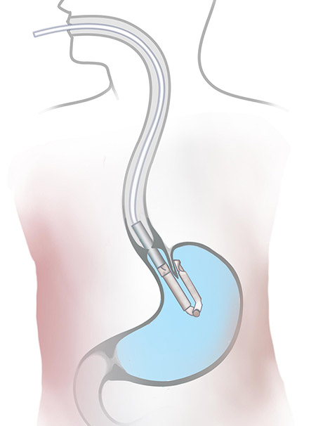 The TIF Procedure